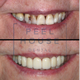 Zirconia Crowns and Bridge