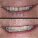 Dental Implant, Veneers, Crowns
