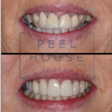 Ceramic Crowns