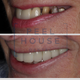Implants and Ceramic Crowns