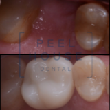 Single Implant